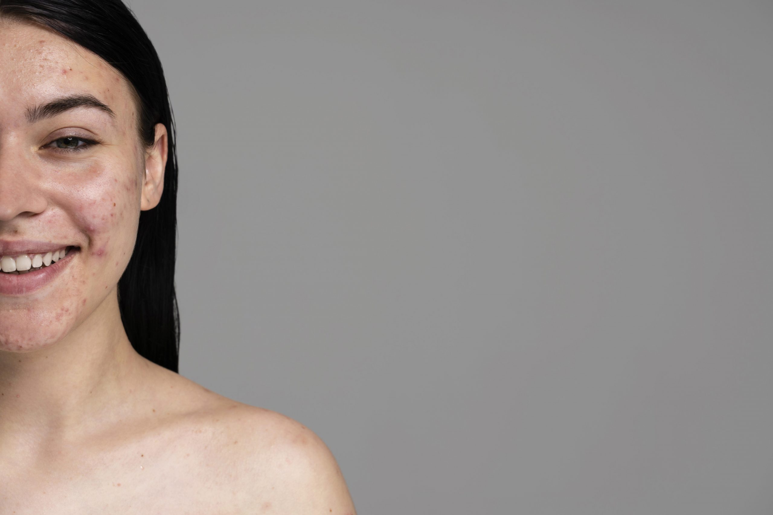 acne image de freepik