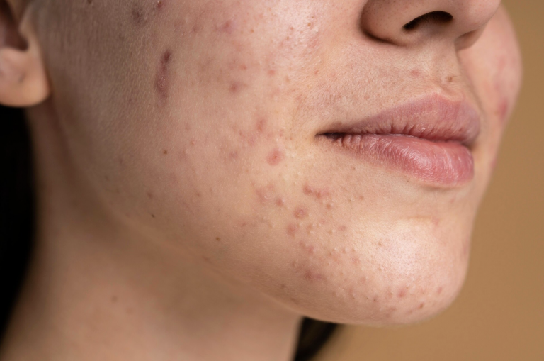 acne ajaccio